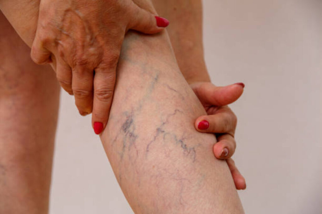Center for Advanced Vein Care