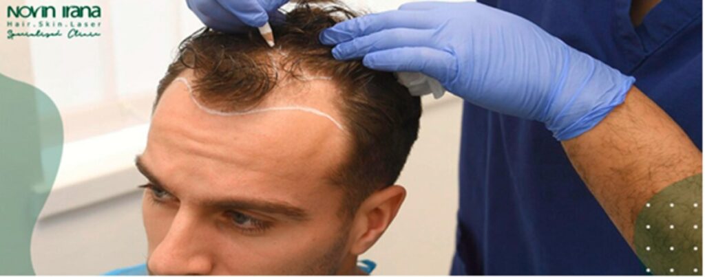 الشروط لزراعة الشعر