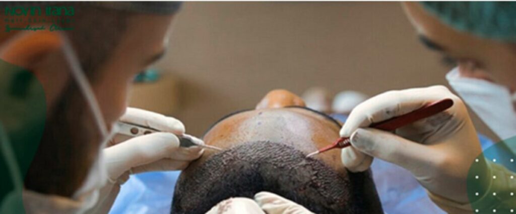 الشروط لزراعة الشعر 1