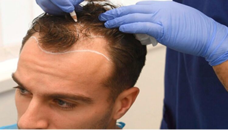 الشروط لزراعة الشعر